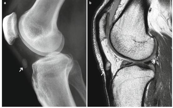 髕腱炎成為醫(yī)學(xué)焦點，從幕后走向舞臺中央的最新進展