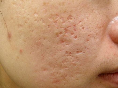 最新痘坑撫平神器，科技重塑肌膚之美，自信生活從此開始